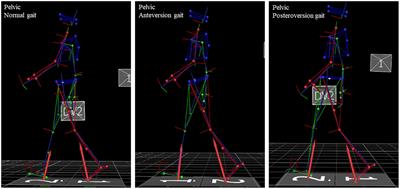 Influence of sagittal pelvic attitude on gait pattern in normally developed people and interactions with neurological pathologies: A pilot study